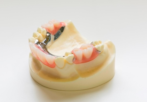 ３歯以上の欠損に対するミラクルデンチャー