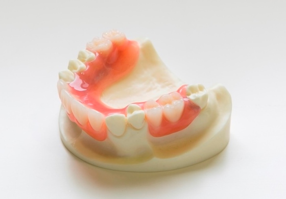 ３歯以上の欠損に対するミラクルデンチャー