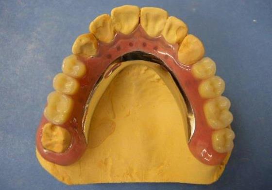 3歯以上の欠損に対するミラクルデンチャー