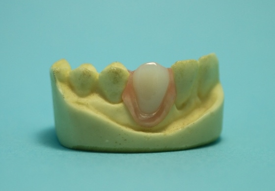 １～２歯の欠損に対するミラクルデンチャー