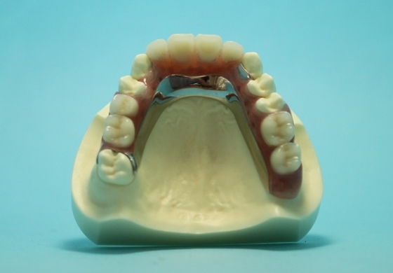 ３歯以上の欠損に対するミラクルデンチャ